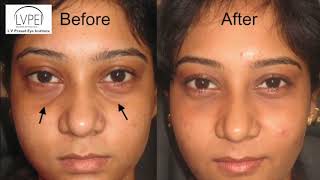 Under Eye Fillers [upl. by Sadella]