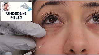 Undereye Filler By Leif Rogers MD FACS  Fanning Technique  Beverly Hills [upl. by Silvia868]