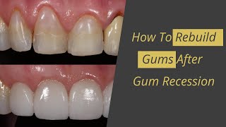 Gum Recession Cure  How to Rebuild Gums [upl. by Jim493]